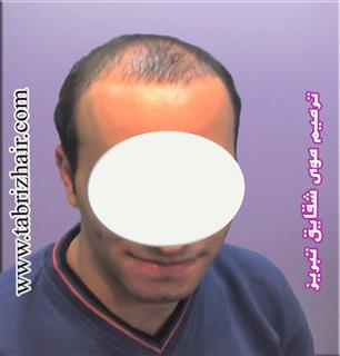 کاشت و ترمیم موی شقایق در تبریز